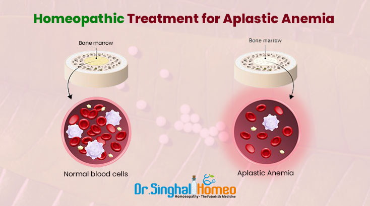 What is the Best Treatment for Aplastic Anemia?