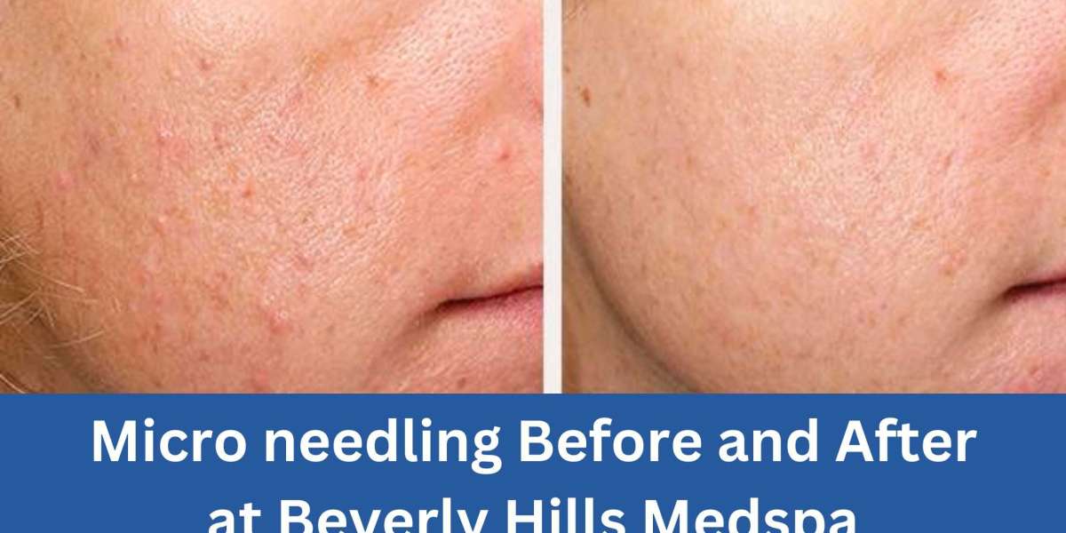 Micro needling Before and After at Beverly Hills Medspa